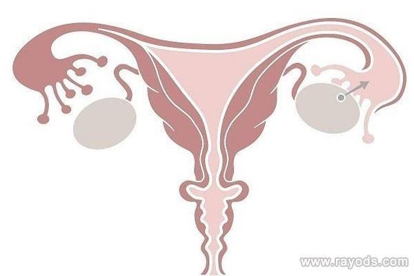 为什么在试管婴儿前需要进行卵巢评估？